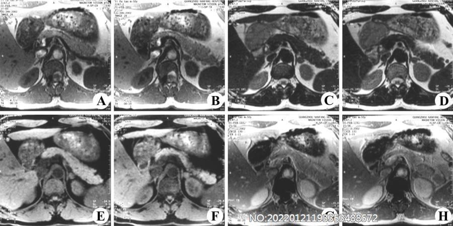 图6-203左侧肾上腺腺瘤MRI.jpg