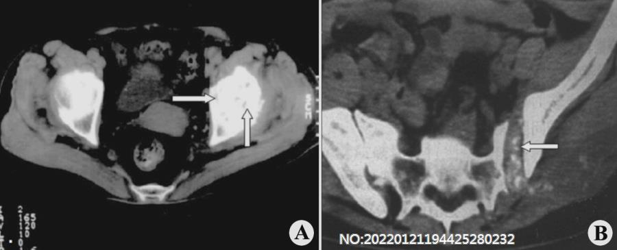 图8-137左髋关节及左骶髂关节结核CT表现.jpg