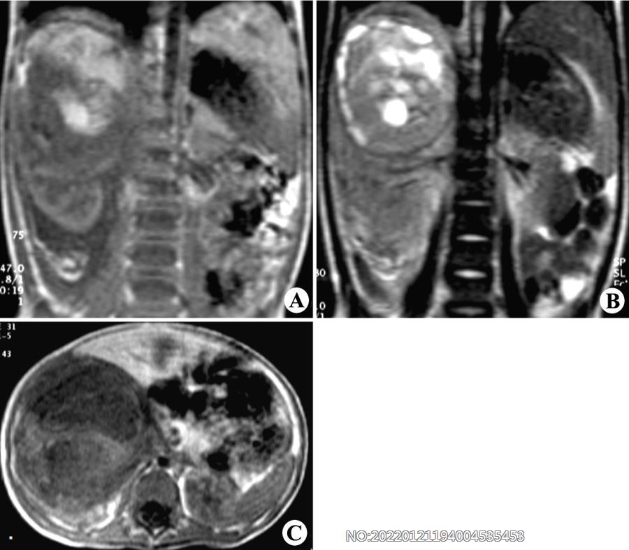 图6-123右肾母细胞癌MRI.jpg