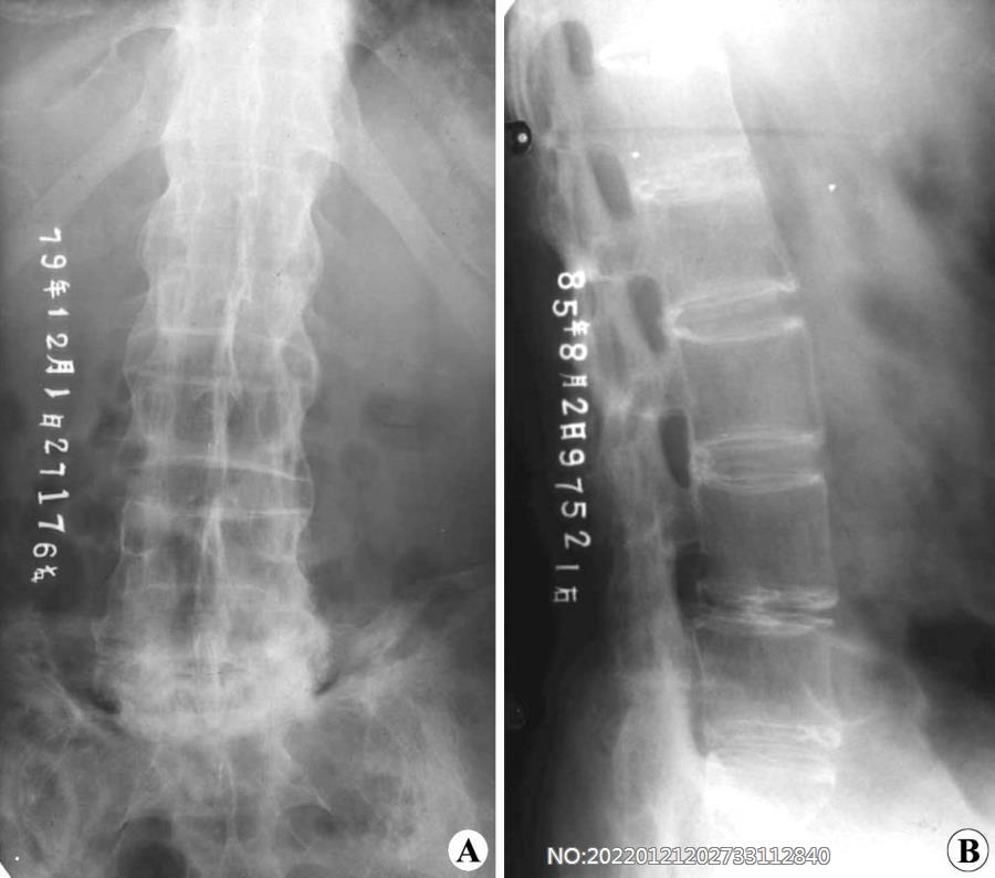 图8-156强直性脊柱炎X线表现-竹节椎.jpg