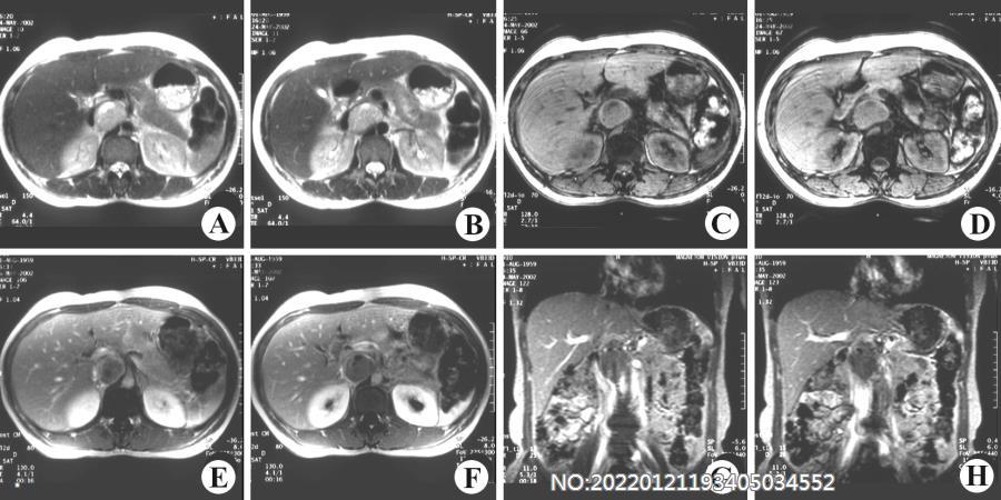 图6-197腹膜后嗜铬细胞瘤MRI.jpg