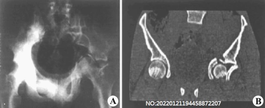 图8-87髋关节脱位X线及CT表现.jpg