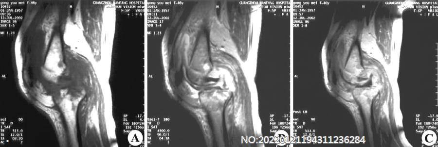 图8-141右膝关节结核MRI表现（进展期）.jpg