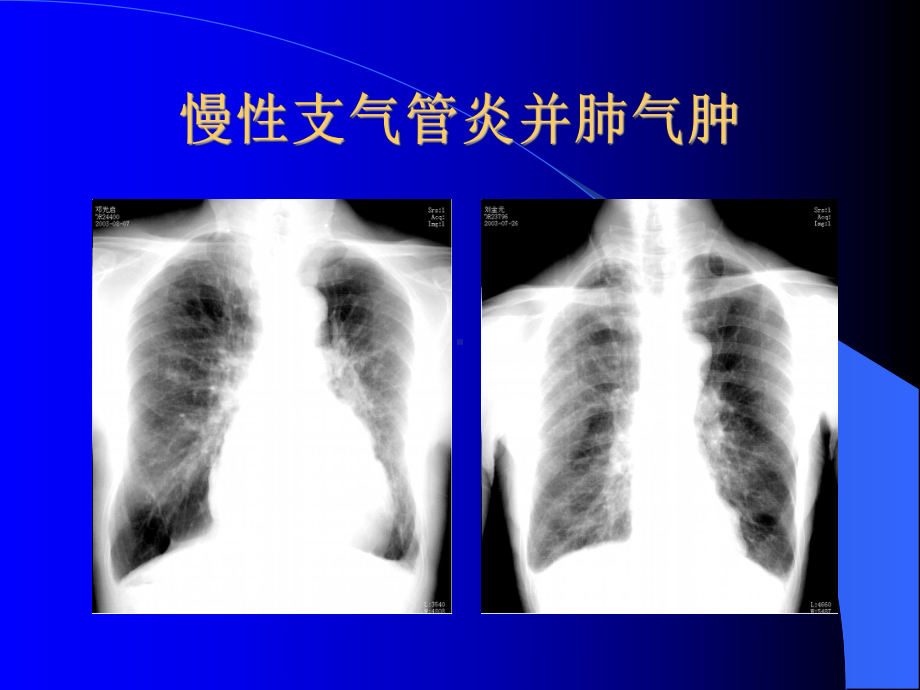 影像学课件：基本病变（第二次课）.ppt_第3页