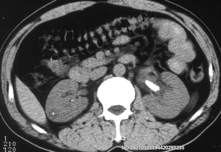 图6-58左肾结石CT.jpg