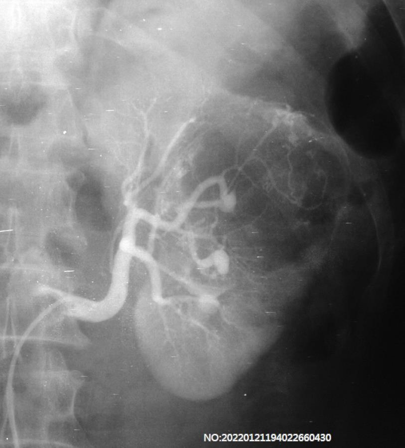 图6-132左肾错构瘤.jpg