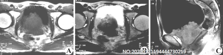 图7-63前列腺癌MRI.jpg