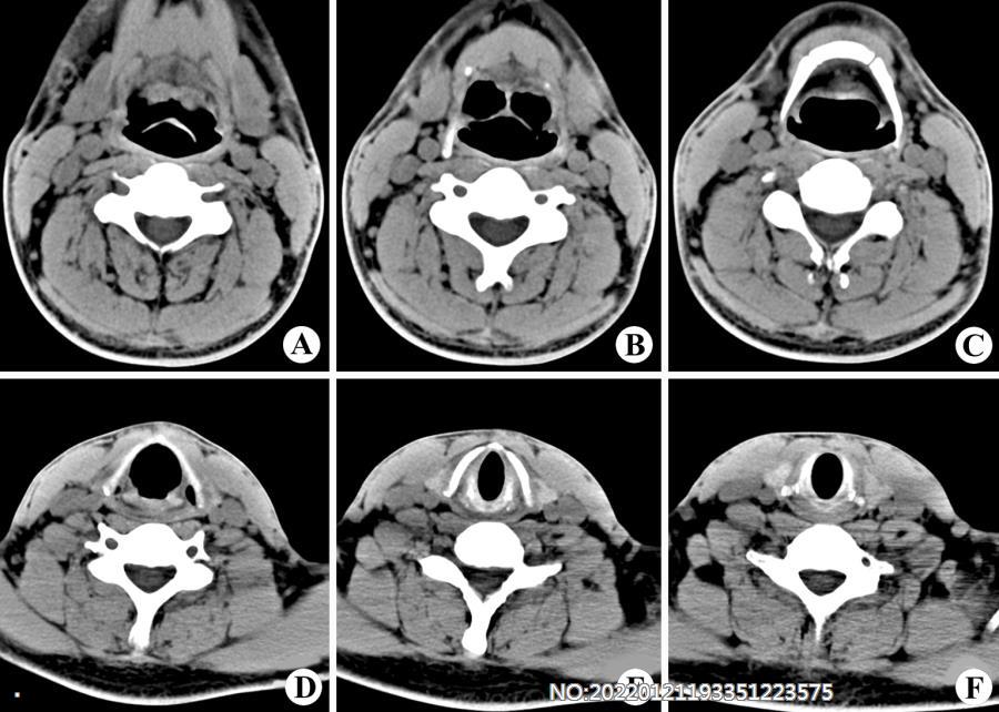 图2-79正常喉部及下咽部CT表现.jpg