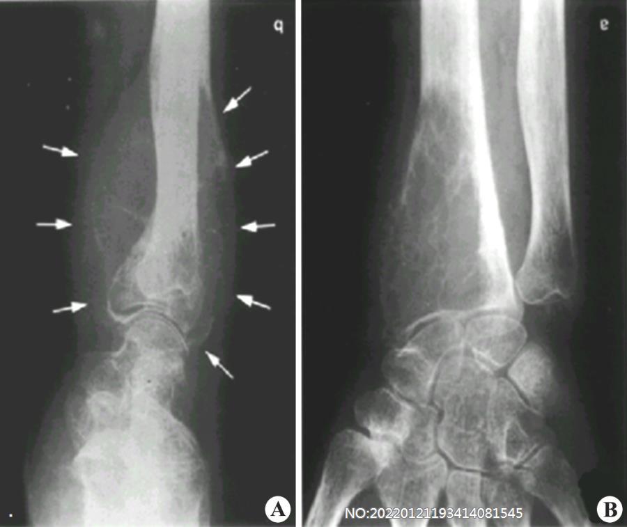 图8-201骨巨细胞瘤X线表现-生长活跃.jpg
