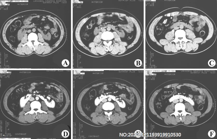 图6-41马蹄肾CT.jpg