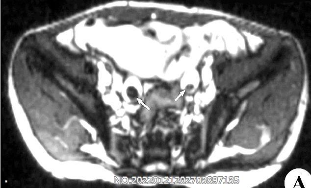 双侧输尿管结石MRI.jpg