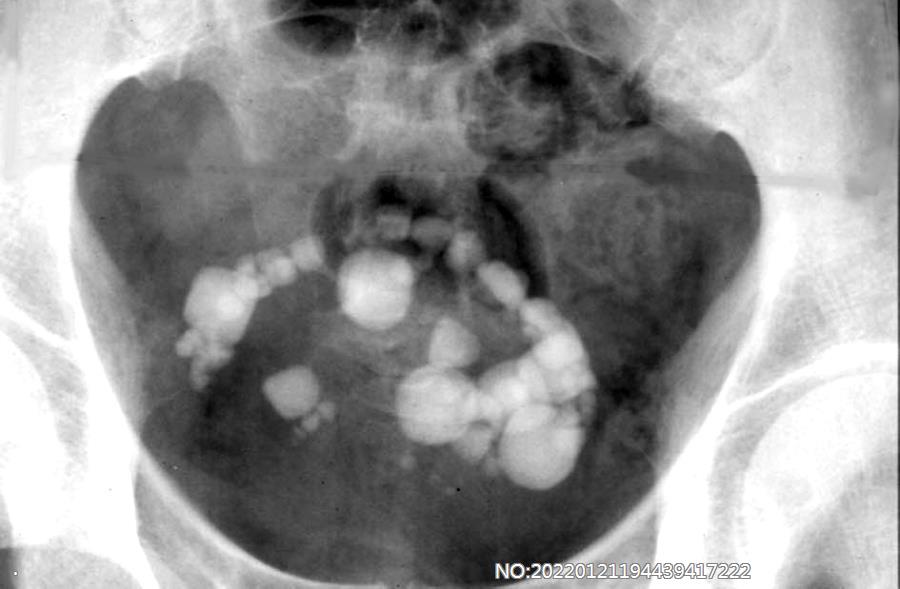 图6-73膀胱多发结石.jpg