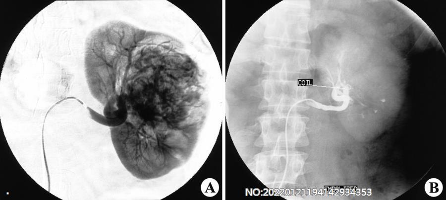 图6-103左肾癌DSA及栓塞治疗.jpg