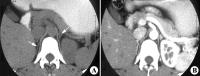 图6-190正常肾上腺CT.jpg