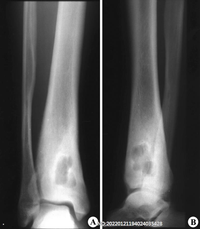 图8-111慢性骨脓肿X线表现.jpg