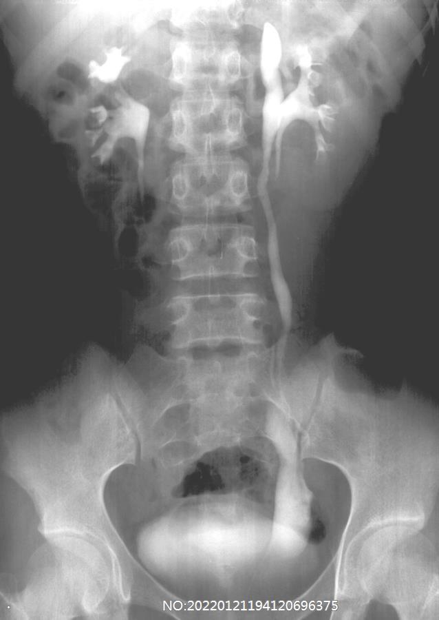 图6-24左侧双肾盂和输尿管重复畸形.jpg