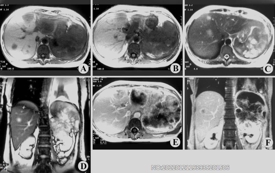 图6-112左肾癌MRI.jpg