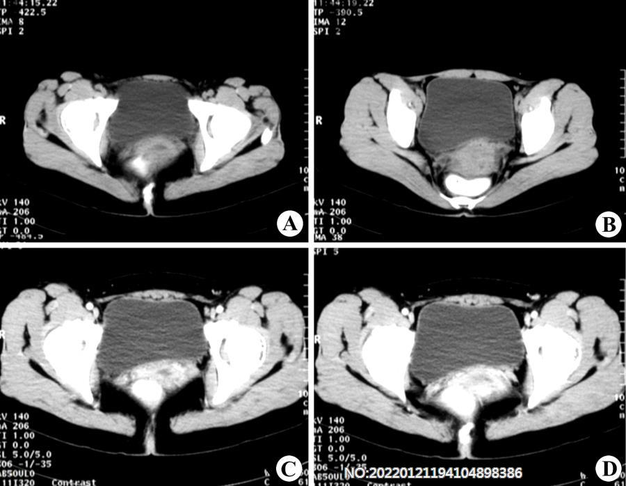 图7-30子宫颈癌CT.jpg