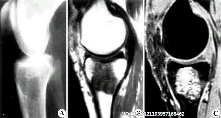 图8-206骨巨细胞瘤X线及MRI表现.jpg
