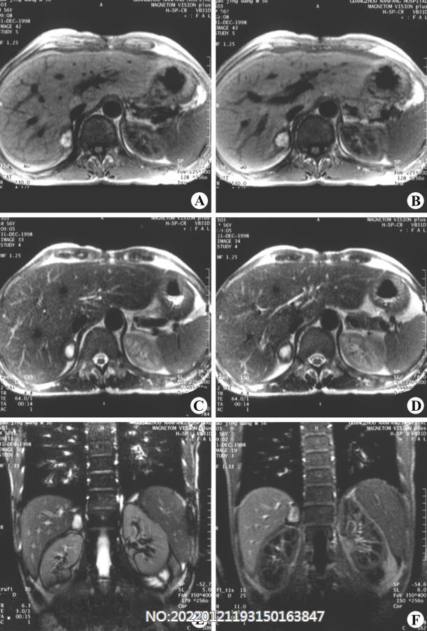 图6-211右肾上腺囊肿MRI.jpg