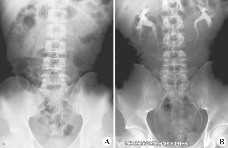 图6-4（A）正常腹平片（B）静脉肾盂造影（IVP）.jpg