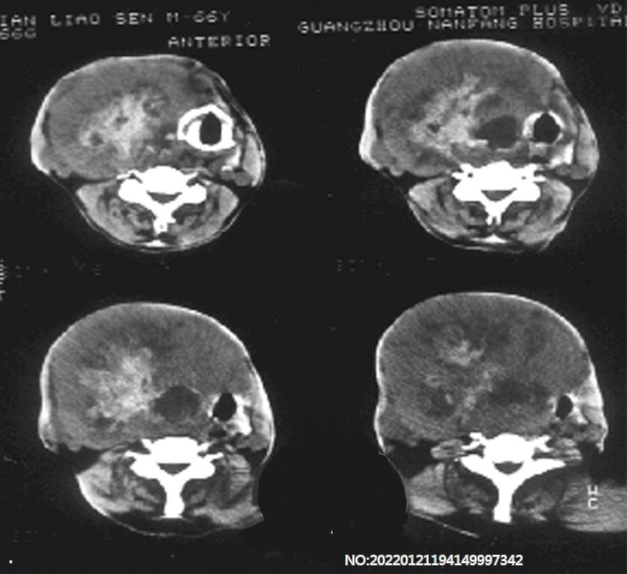 图2-109甲状腺癌.jpg