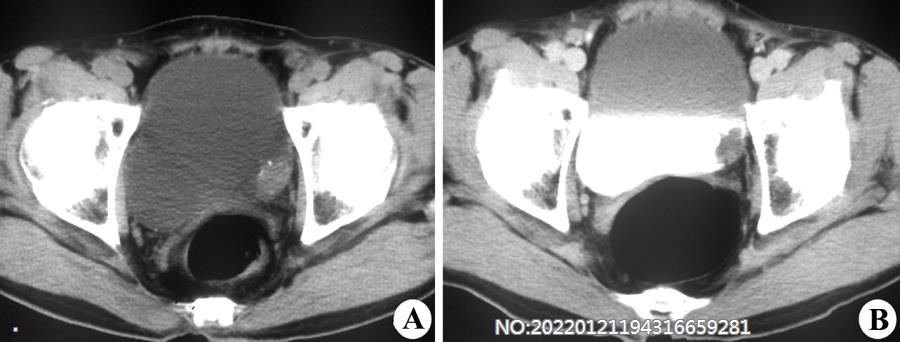 图6-147膀胱癌CT.jpg