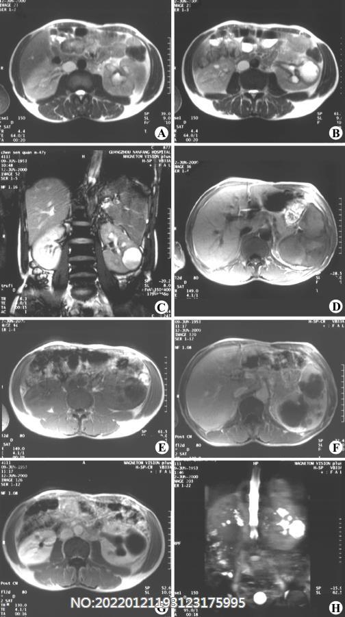 图6-91左肾、输尿管、膀胱及脾结核MRI.jpg