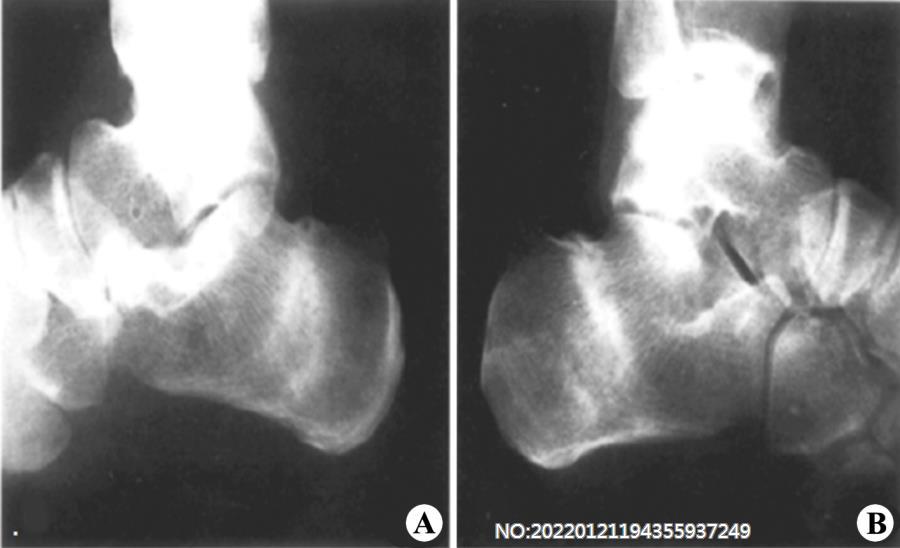 图8-81双跟骨疲劳骨折.jpg