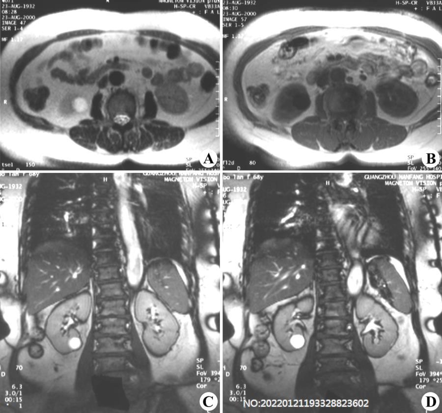 图6-174右肾下极囊肿MRI.jpg