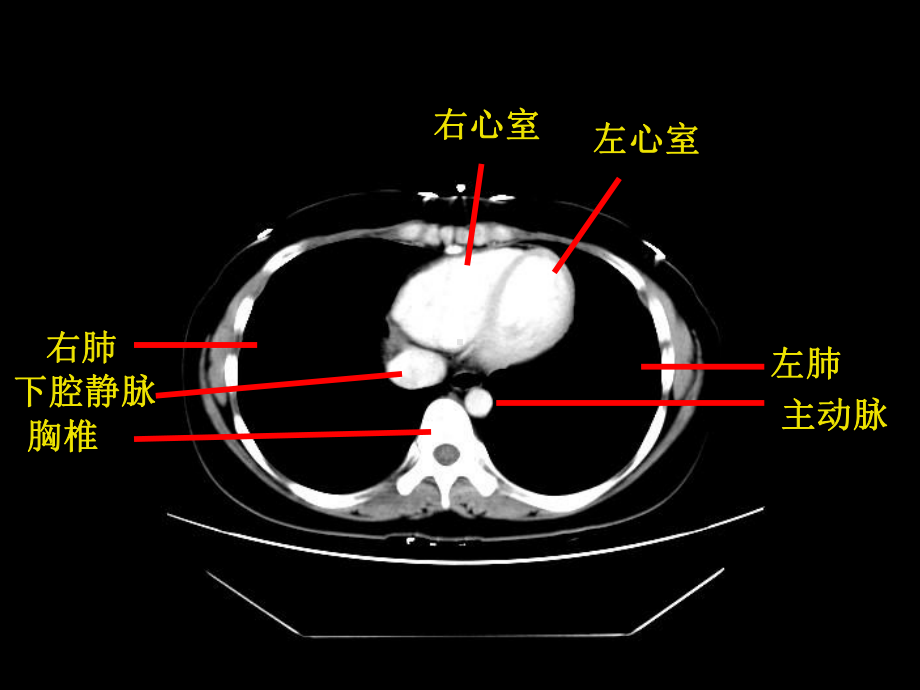 影像学课件：正常 - CT.ppt_第2页