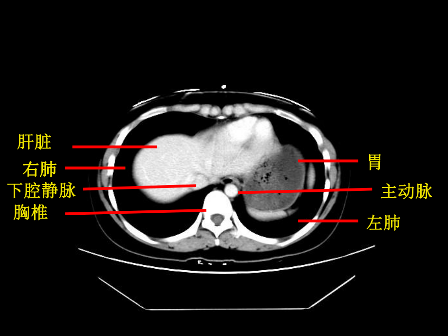 影像学课件：正常 - CT.ppt_第3页