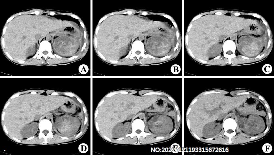 图6-181左肾挫伤并出血CT.jpg