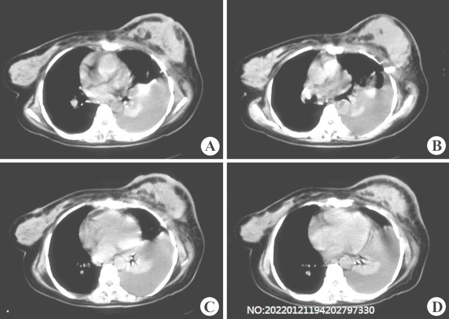 图7-72左乳腺癌CT.jpg