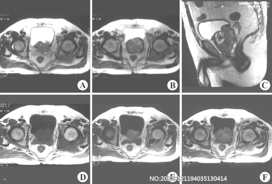 图7-64前列腺癌MRI.jpg