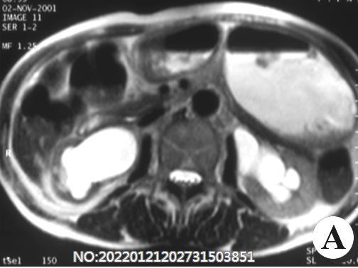 双肾及双输尿管积水MRI.jpg