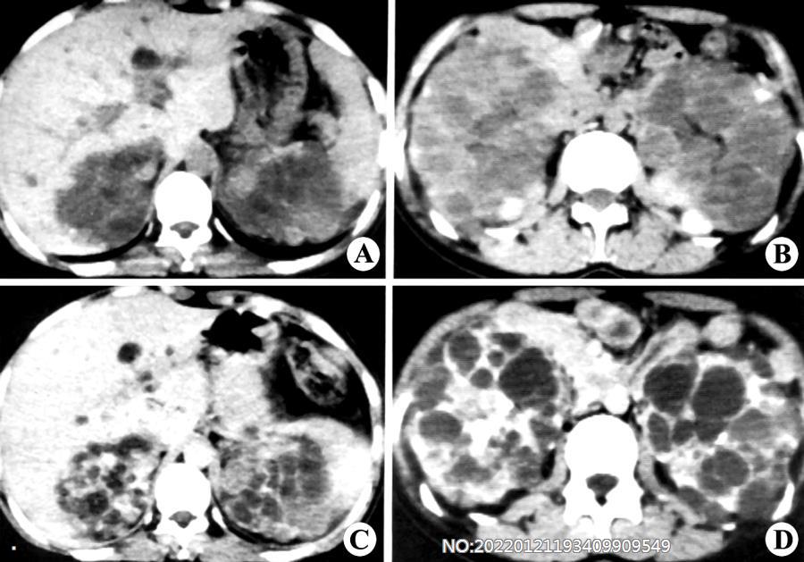 图6-155多囊肾CT.jpg
