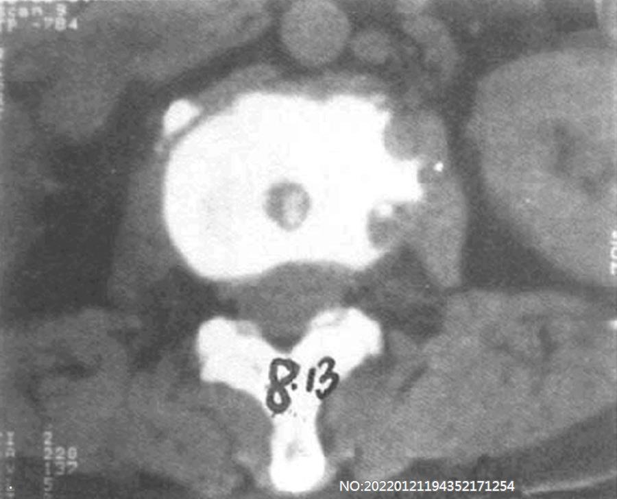 图8-126腰1-2椎体结核CT表现.jpg