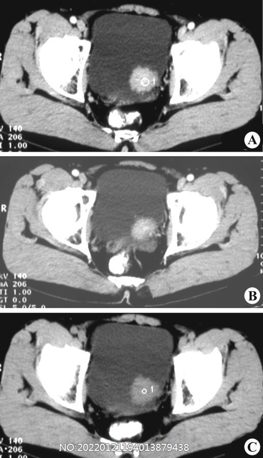 图6-145膀胱癌CT.jpg
