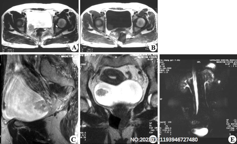 图6-151膀胱癌MRI.jpg