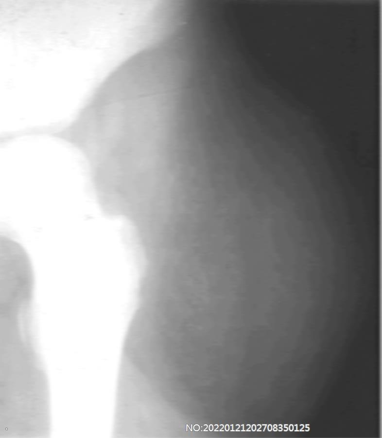 图8-52软组织肿块X线表现.jpg