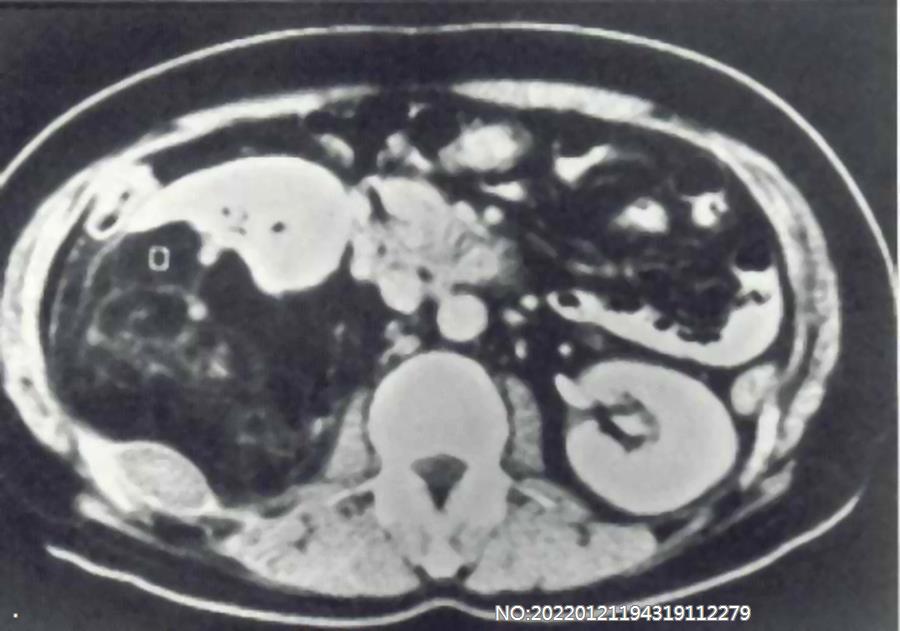图6-135右肾血管平滑肌脂肪瘤CT.jpg