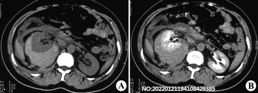 图6-179右肾周血肿CT.jpg