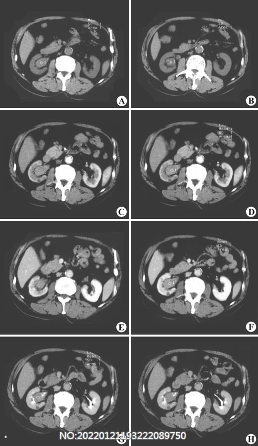 图6-128右肾盂癌CT.jpg