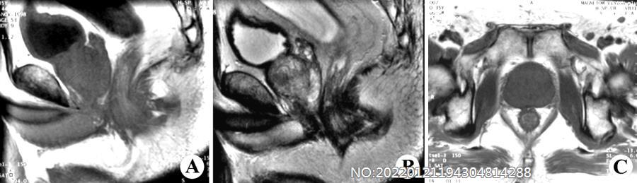 图7-57前列腺增生MRI.jpg