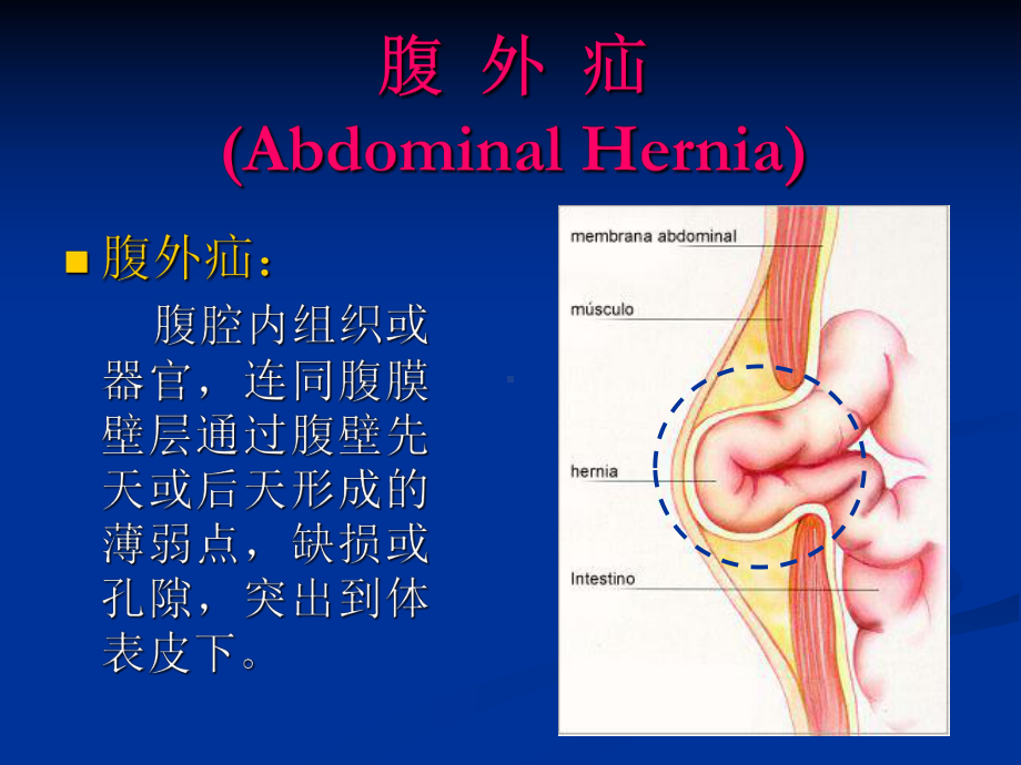 外科二课件：腹股沟疝2017.ppt_第3页