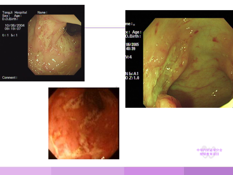 内科一课件：溃疡性结肠炎.ppt_第2页