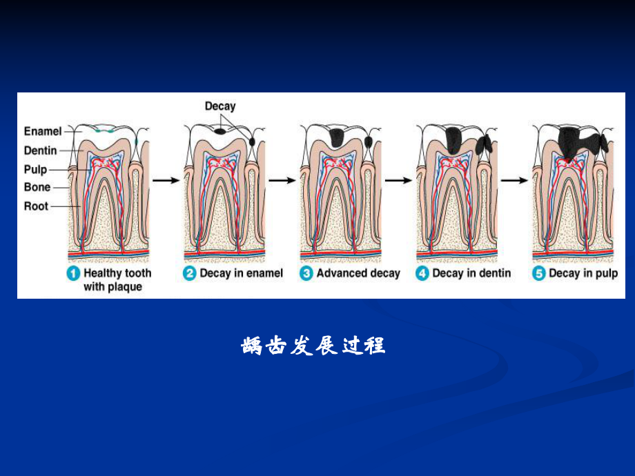 口腔科学课件：牙体牙髓&牙周常见病.ppt_第3页