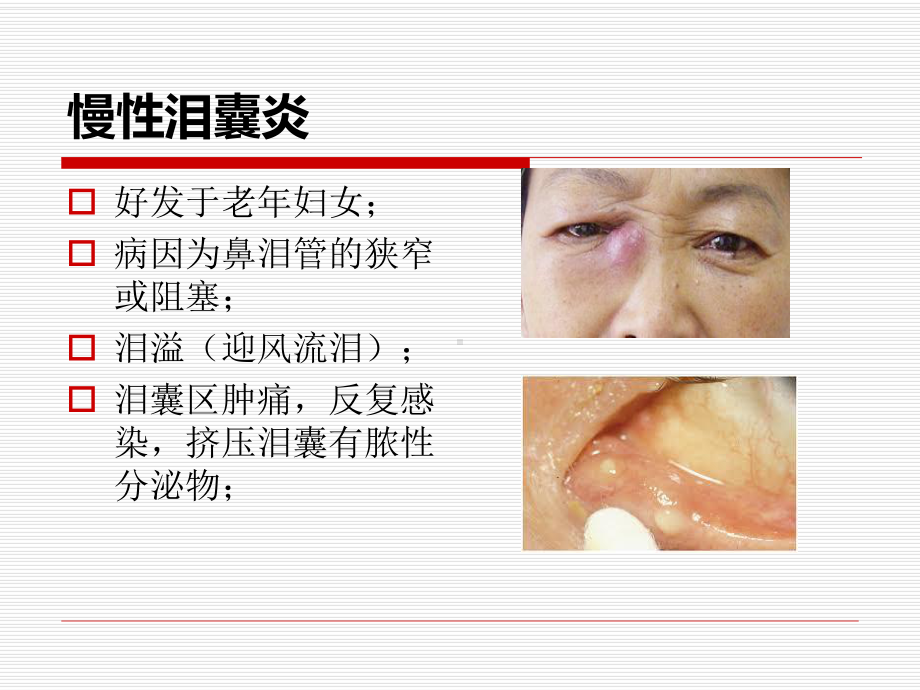 鼻内镜鼻腔泪囊吻合术PPT医学课件.ppt_第3页