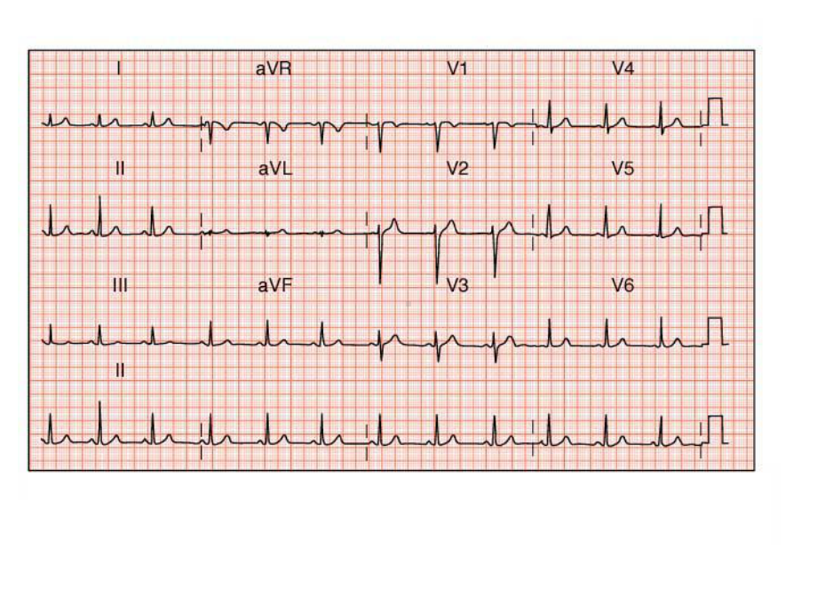 循环系统内科学心律失常-英文教学课件：Arrhythmia Diagnosis and Management.ppt_第3页